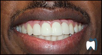 Smile makeover case study 11 — after treatment