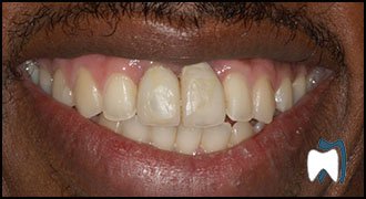 Smile makeover case study 11 — before treatment