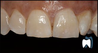 Smile makeover case study 12 — after treatment