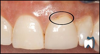 Smile makeover case study 12 — before treatment