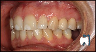 Smile makeover case study 13 — after treatment