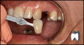 Smile makeover case study 13 — before treatment