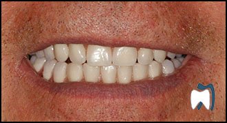 Smile makeover case study 14 — after treatment