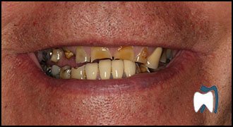 Smile makeover case study 14 — before treatment