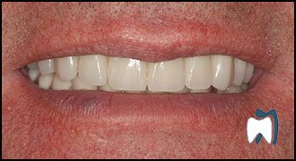 Smile makeover case study 15 — after treatment