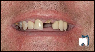Smile makeover case study 15 — before treatment