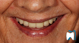 Smile makeover case study 16 — after treatment
