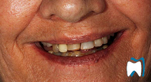 Smile makeover case study 16 — before treatment