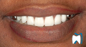 Smile makeover case study 17 — after treatment