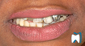 Smile makeover case study 17 — before treatment
