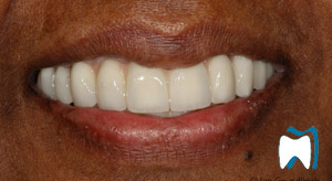 Smile makeover case study 2 — after treatment