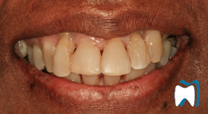 Smile makeover case study 2 — before treatment