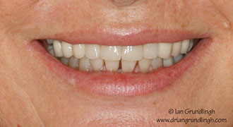 Smile makeover case study 3 — after treatment