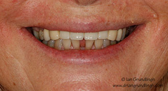 Smile makeover case study 3 — before treatment