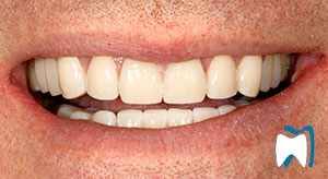 Smile makeover case study 4 — after treatment