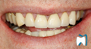 Smile makeover case study 4 — before treatment