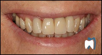 Smile makeover case study 5 — after treatment