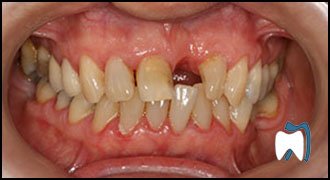 Smile makeover case study 5 — before treatment