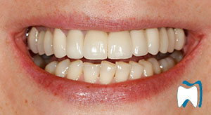 Smile makeover case study 6 — after treatment