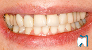 Smile makeover case study 6 — before treatment