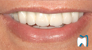 Smile makeover case study 7 — after treatment
