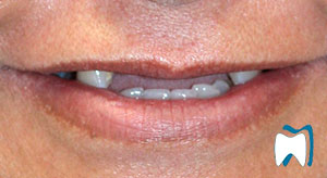 Smile makeover case study 7 — before treatment