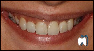 Smile makeover case study 8 — after treatment