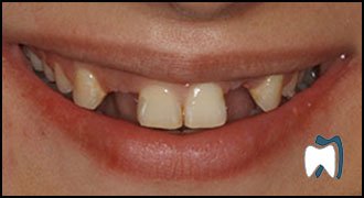Smile makeover case study 8 — before treatment