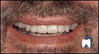 Smile makeover case study 9 — after treatment