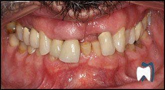 Smile makeover case study 9 — before treatment