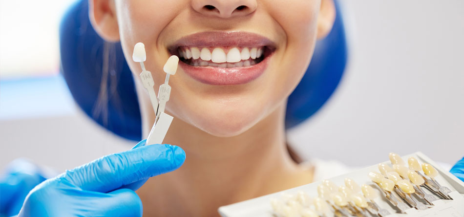 Veneers